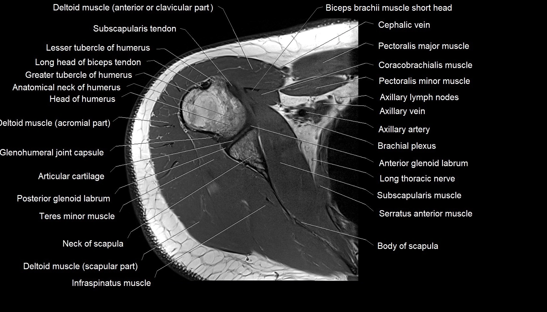 Shoulder cross sectional anatomy MRI 3T axial image 23.webp
